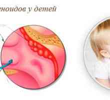 Adenoidy u detí: príznaky a liečba