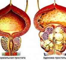 Adenóm prostaty: liečba ľudovými prostriedkami