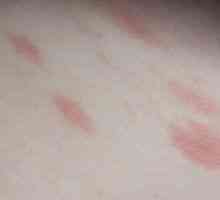 Alergie na kožu, červené škvrny sú svrbenie: liečba