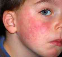 Alergia na mlieko u dieťaťa, príznaky a vývoj