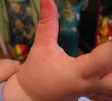 Alergie na prstoch dieťaťa a na rukách