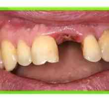 Alveolitída po liečbe a prevencii extrakcie zubov