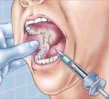 Anestézia v stomatológii: typy, popis a metódy