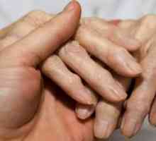 Artritída prstov: príznaky ochorenia a nevyhnutná liečba