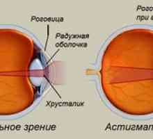 Astigmatizmus oka: čo to je, foto, liečba u dospelých