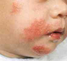 Atopická dermatitída u detí: fotografie symptómov a liečba