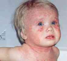 Atopická dermatitída u dieťaťa s fotkou