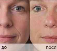 Neinjektívna biorevitalizácia tváre kyselinou hyalurónovou