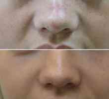 Neorurgická rinoplastika nosa s plničkami a vláknami