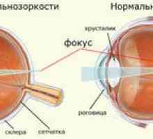 Myopia, hyperopia. Prečo sa lúče nezameriavajú na sietnicu?