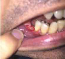 Poškodenie ďasien po extrakcii zubov, čo robiť