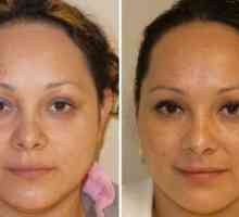 Botox pre tvár: kontraindikácie pred a po