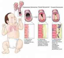 Bronchitída u detí: názory Komarovského a konkrétne liečenie