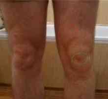 Bursitída kolena: príznaky a liečba
