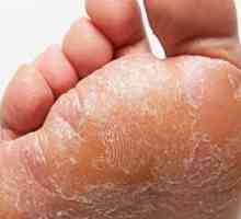 Ako liečiť hubu nohy: prípravu chemikov a národných agentov