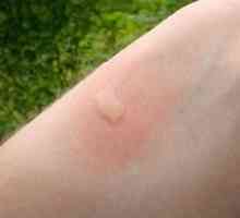 Čo potrebujete na uhryznutie kosení komára na dieťa