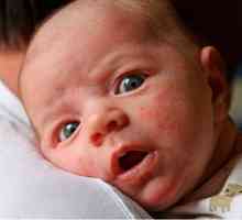 Čo robiť, ak má novorodenca vyrážku na tvári