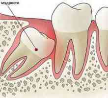 Čo robiť po múdrosti extrakcie zubov