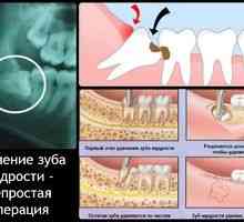 Čo robiť po extrakcii zubov: potrebné odporúčania