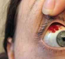 Čo robiť, ak krvácanie oka: symptómy a liečba