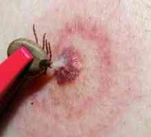 Čo je Lyme choroba: Príčiny, príznaky a liečba