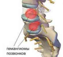 Čo to je - spinálny hemangióm, spôsoby jeho liečby
