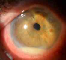 Čo je to - ochorenie očí iridocyklitis