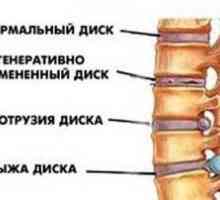 Čo to je - vyčnievanie chrbtových kotúčov a ako ich liečiť