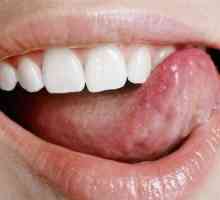 Čo sú biele rany v ústach?
