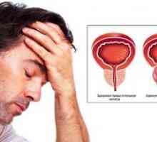Čo je adenóm prostaty u mužov: príčiny, symptómy a liečba