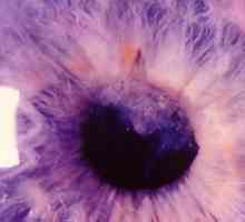 Čo je aphakia, znaky tejto patológie oka