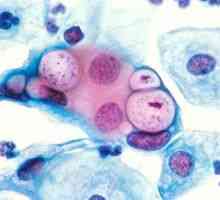 Čo je chlamydia trachomatis: príznaky a liečba chlamýdií