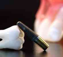 Čo je zubná implantácia zubov: typy a popis