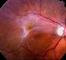 Čo je epiretinálna fibróza oka?