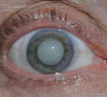 Čo je to očné šľachy, príznaky