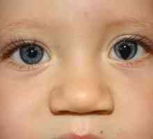 Čo je kolobóm oka dúhovky a očných viečok