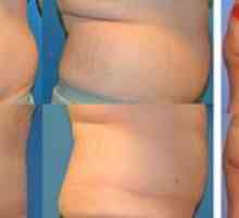 Čo je liposukcia: typy, plusy a mínusy procedúry