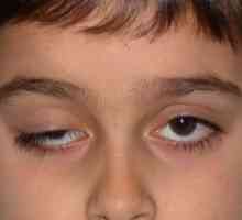 Čo je ptóza horného očného viečka: príčiny a liečba bez operácie