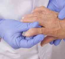 Čo je ochorenie artritída a ako ju liečiť