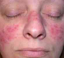 Demodikóza na tvári u žien: príznaky, fotky choroby