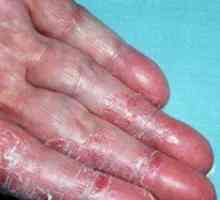 Dermatitída na rukách: liečba a fotografie