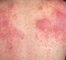 Dermatitída: typy, fotografie príznakov a liečba