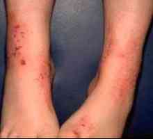 Detská dermatitída na chodidle: fotografie, typy a spôsoby liečby