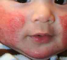 Diatéza na lícach liečby detí