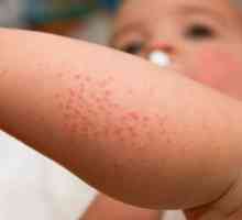 Diéta u detí s atopickou dermatitídou