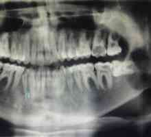Čo je röntgenový zub v zubnom lekárstve?