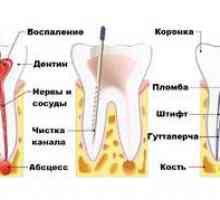 Dlhé bolesti zubov po odstránení nervu