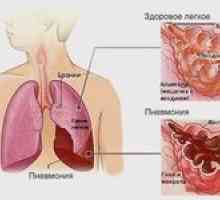 Obojstranná pneumónia: ako liečiť zápal pľúc?