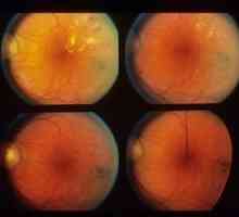 Pozadia retinopatie a vaskulárne zmeny sietnice
