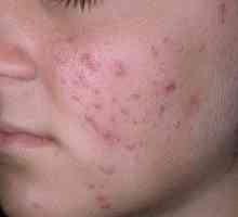 Foto akné na tvári a liečbu